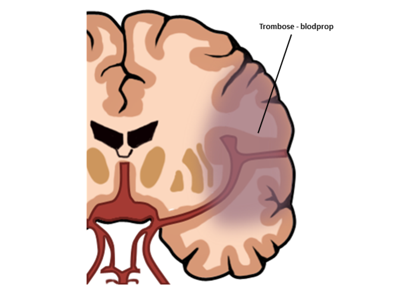 Blodprop | Neurorehabilitering – Kbh