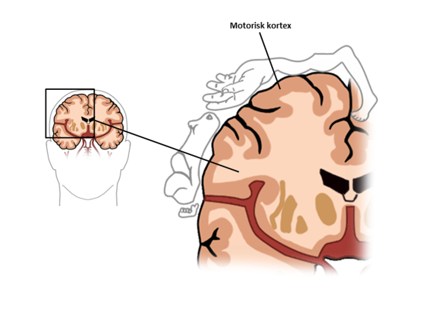 Hemiplegi Neurorehabilitering Kbh