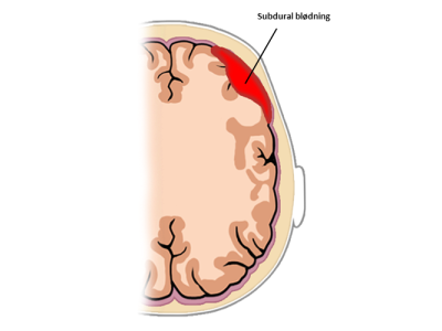 Subduralt H matom Neurorehabilitering Kbh subduralt-h-matom-neurorehabilitering-kbh