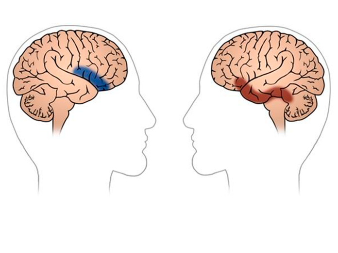 Illustration af to hjerner, der fremhæver præfrontale områder i hjernen, hvor skader ofte vil lede til abstraktionsvanskeligheder.