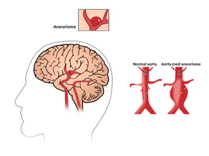 Illustration af, hvordan en aneurisme i hjernen ser ud. ved siden af er der en illustration af en normal aorta ved siden af en aorta med en aneurisme.