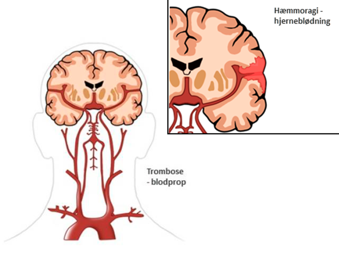 Illustration af en hjerne set fra baghovedet, der viser, hvordan en blodprop (trombose) ser ud. Ved siden af en illustration af en hjerne, der viser, hvordan en hjerneblødning ser ud. 