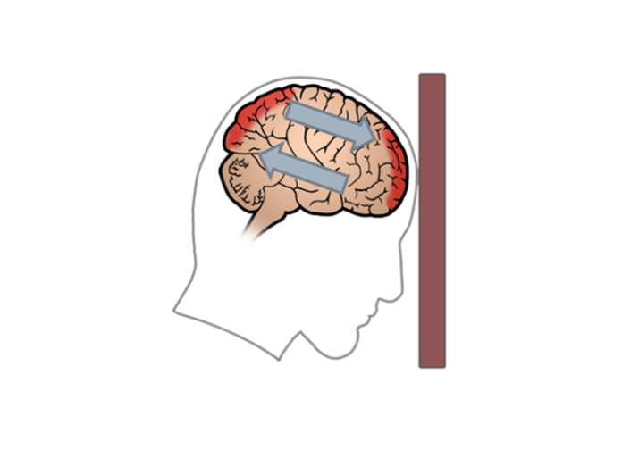 Illustration af, hvordan hjernens væv bliver beskadiget, når hjernen støder mod kraniekassen forrest og bagerst i hovedet. 