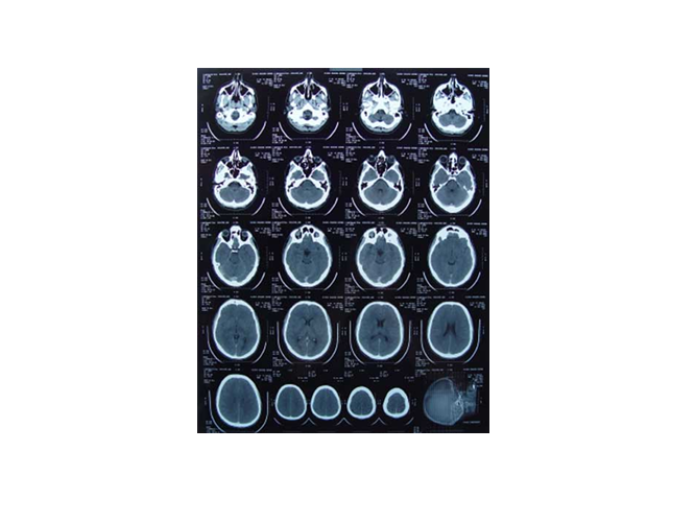 Billedet viser en udskrift af en CT-scanning af en hjerne, hvor man ser hjernen fra forskellige vinkler. 