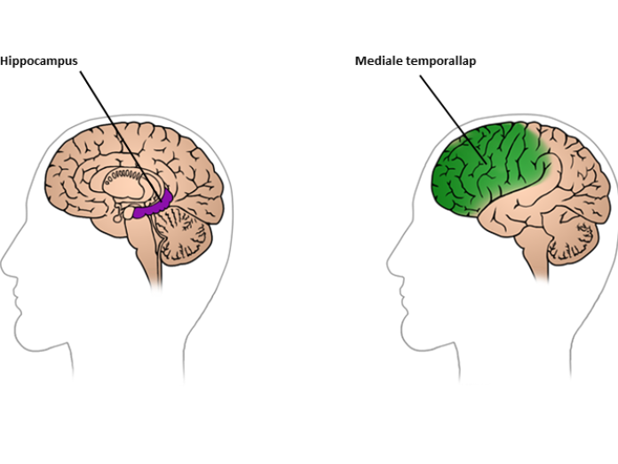 Illustration af to hjerne, hvor der i den ene er fremhævet hippocampus, og i den anden er fremhævet mediale temporallap. 