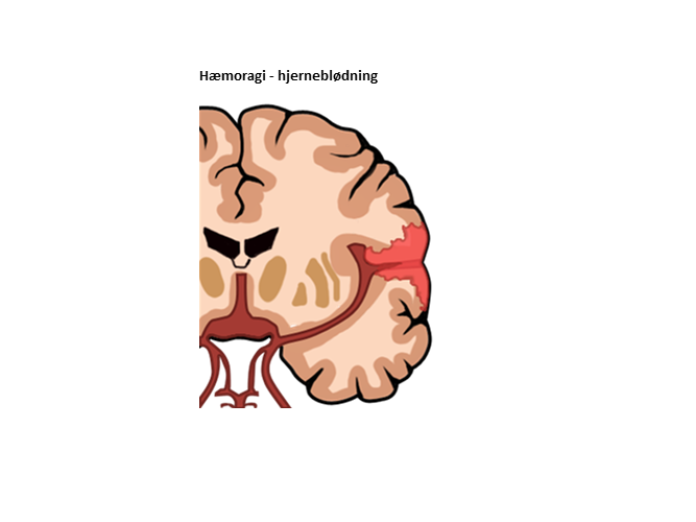 En illustration af en blodsamling i yderst i højre side af en hjerne. 