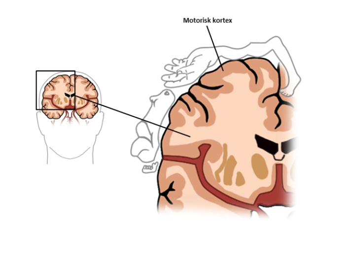 Illustration af et udsnit af en hjernedel, og et eksempel på, hvad en nedsættelse af hjernedelen rammer - i dette tilfælde den ene arm og ben og ansigtsmuskler. 