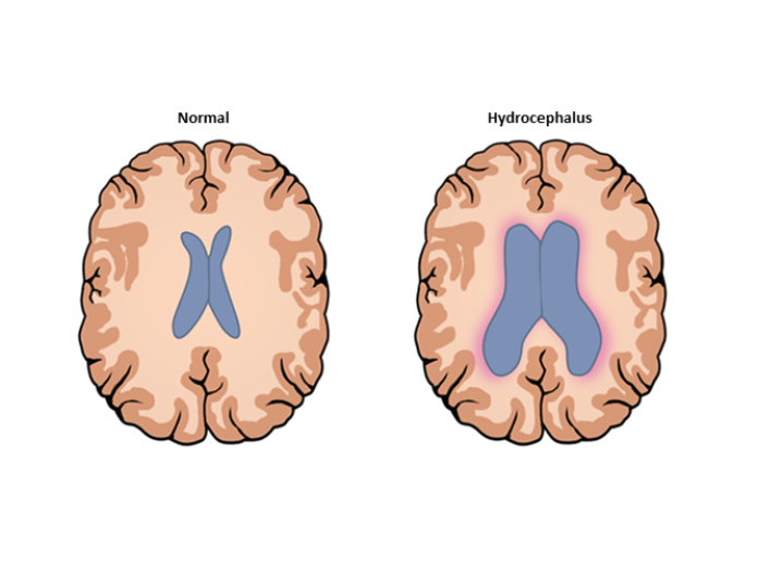 Illustration af to hjerner set oppefra, hvor hjernens hulrum er forstørret i hjernen til højre. 