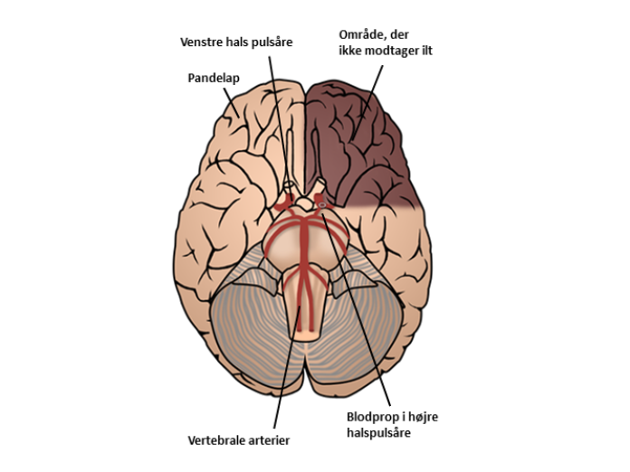 Illustration af hjerne set oppefra, hvor en del af hjernen er "dødt", fordi det har mistet ilt. 