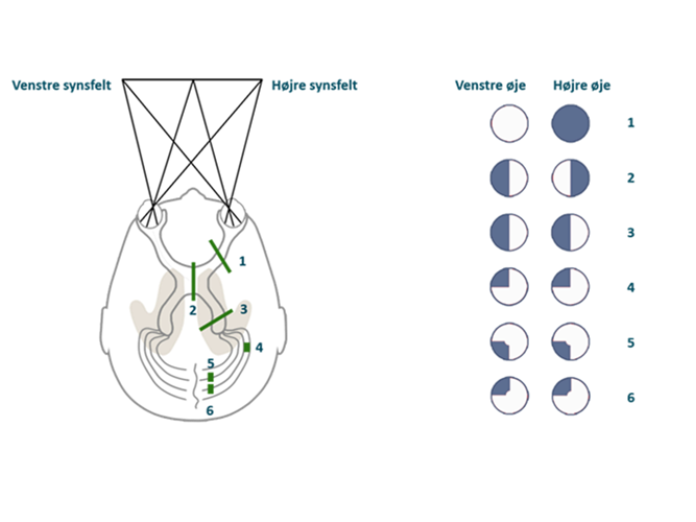 Illustration af hjernen set oppefra, hvor det ses, hvordan synsfeltet påvirkes, alt efter hvor i hjernen en læsion sidder. 