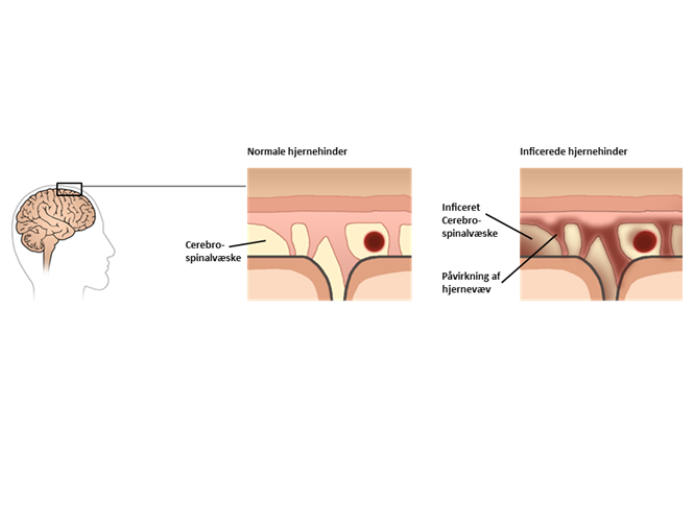 En illustration af forskellen på en normal hjernehinde og en hjernehinde, der er inficeret. 