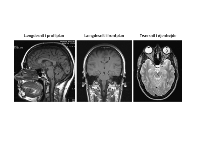En eksempel på, hvordan billeder fra en MR-scanning ser ud. Her ser vi et længdesnit i profilplan, et længdesnit i frontplan og et tværsnit i øjenhøjde.