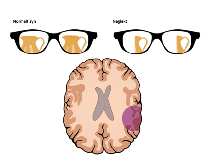 En illustration af, hvordan neglekt påvirker synet. Det er illusteret ved, at der til venstre er et eksempel på, hvordan et normalt syn ser en vase. Og til højre er der et eksempel på, hvordan neglekt påvirker synet, så begge øjne ikke kan se den venstre del af vasen. 
