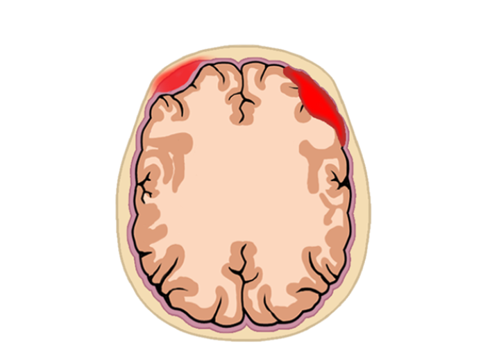 En illustration af rummet mellem to hjernehinder forrest i hjernen. 