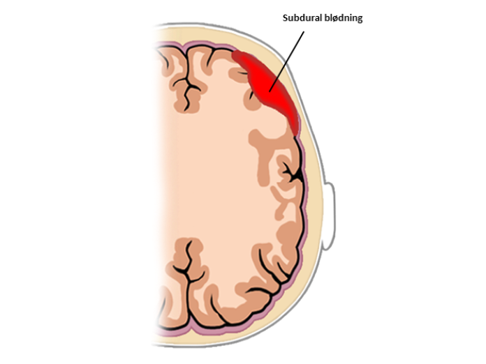 En illustration af en subdural blødning forrest til højre i en hjerne. 