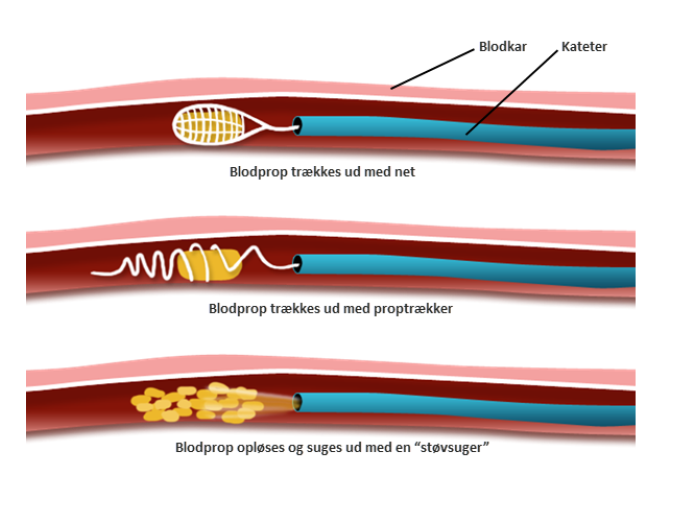 Trombektomi | Neurorehabilitering – Kbh