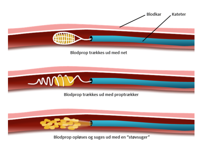 Ilustration af tre metoder til at fjerne en blodprop med trombektomi. 1: ved at trække blodproppen ud med det net. 2: ved at trækker blodproppen ud med en proptrækker. 3: ved at opløse blodproppen og suge den ud med den "støvsuger". 