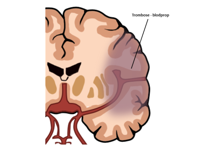 illustration af en blodprop (trombose) i hjernen. 