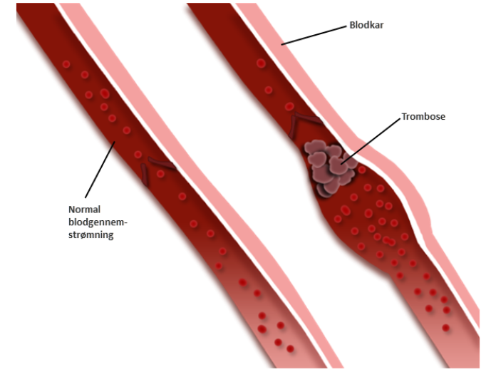 En illustration af forskellen på et normalt blodkar med normal blodgennemstrømning, og et blodkar med trombose. 