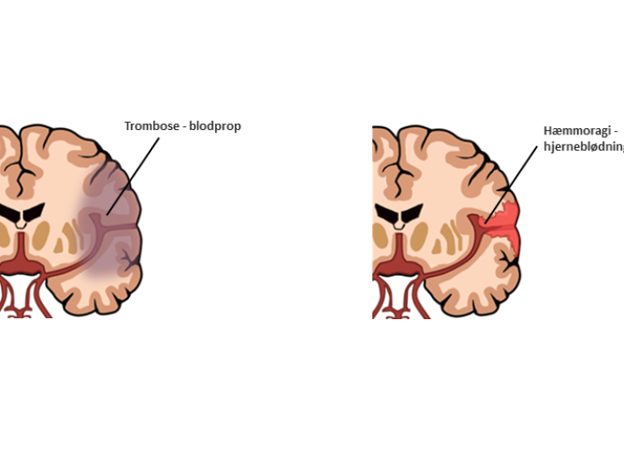 Illustration af to hjerner, hvor den ene har fremhævet trombose (blodprop) og den anden har fremhævet hæmoragi (hjerneblødning).